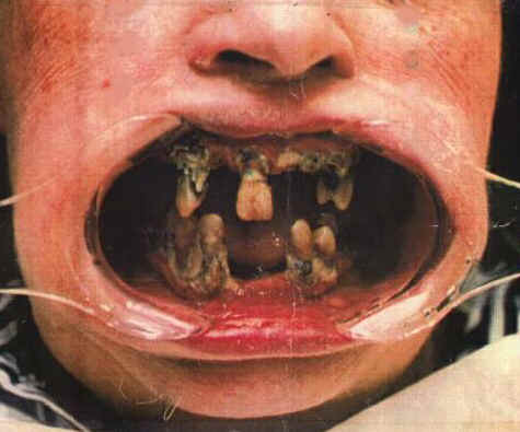 [Image: bad-teeth.jpg]