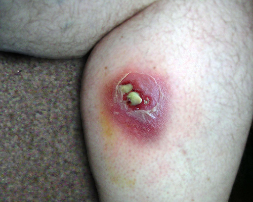 spider bite rash pictures. pimpl